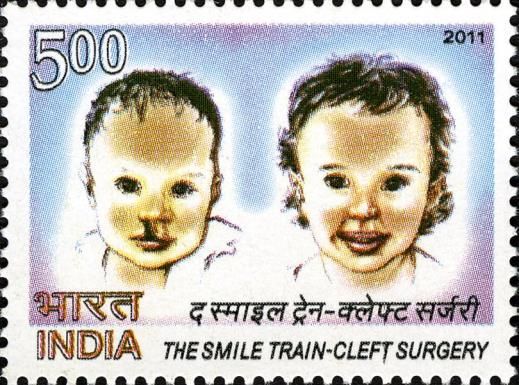 The Smile Train - Cleft Surgery