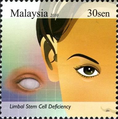 Limbal Stem Cell Deficiency