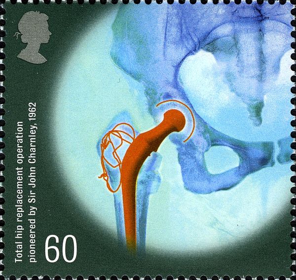 Total Hip Replacement