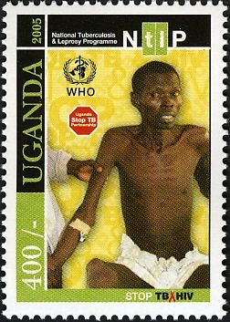Stop TB and HIV